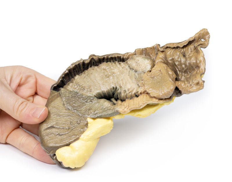 Intussusception af tyndtarmen på grund af metastatisk tumor - eAnatomi