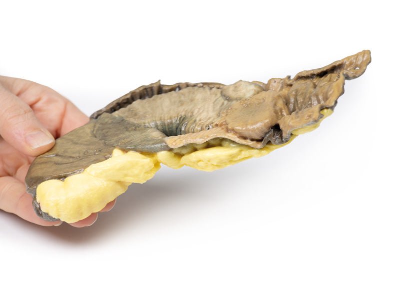 Intussusception af tyndtarmen på grund af metastatisk tumor - eAnatomi