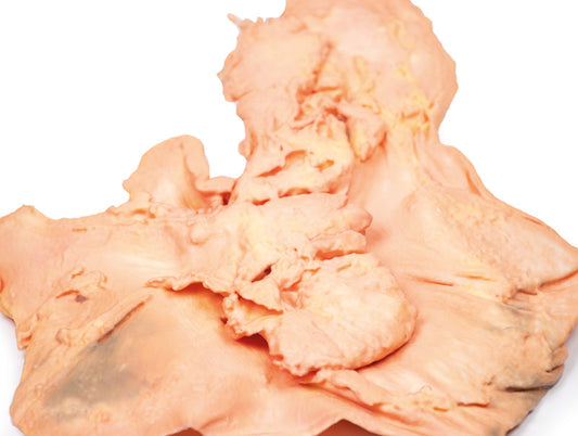 Adenocarcinom i maven