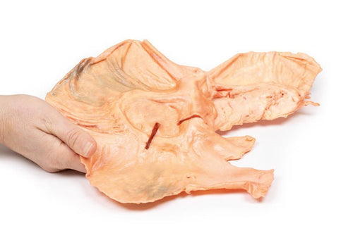 Adenokarcinom i ventriklen - eAnatomi