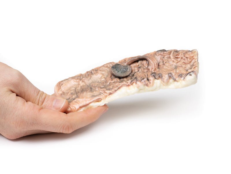 Stilket adenom i colon - eAnatomi