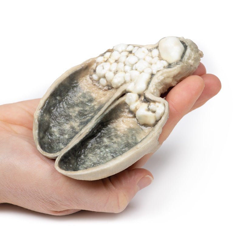 Kolecystitis og kolelithiasis - eAnatomi