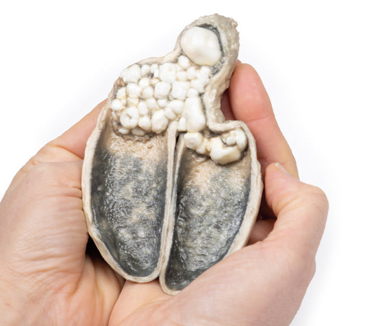 Kolecystitis og kolelithiasis
