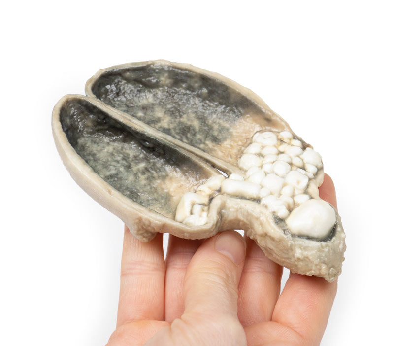 Kolecystitis og kolelithiasis