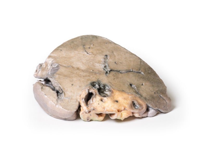 Sten i ductus hepaticus og obstruktiv galdecirrose - eAnatomi