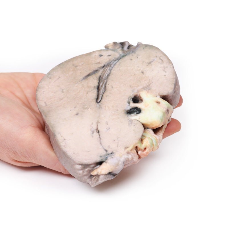 Sten i ductus hepaticus og obstruktiv galdecirrose - eAnatomi