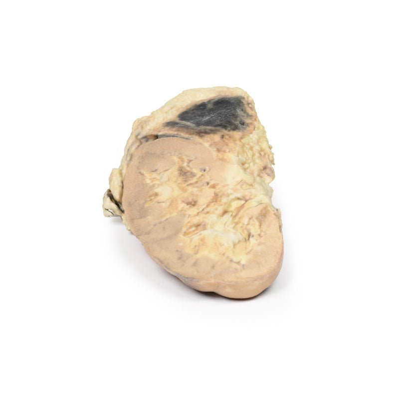 Binyreblødning / Waterhouse - Friderichsens syndrom - eAnatomi