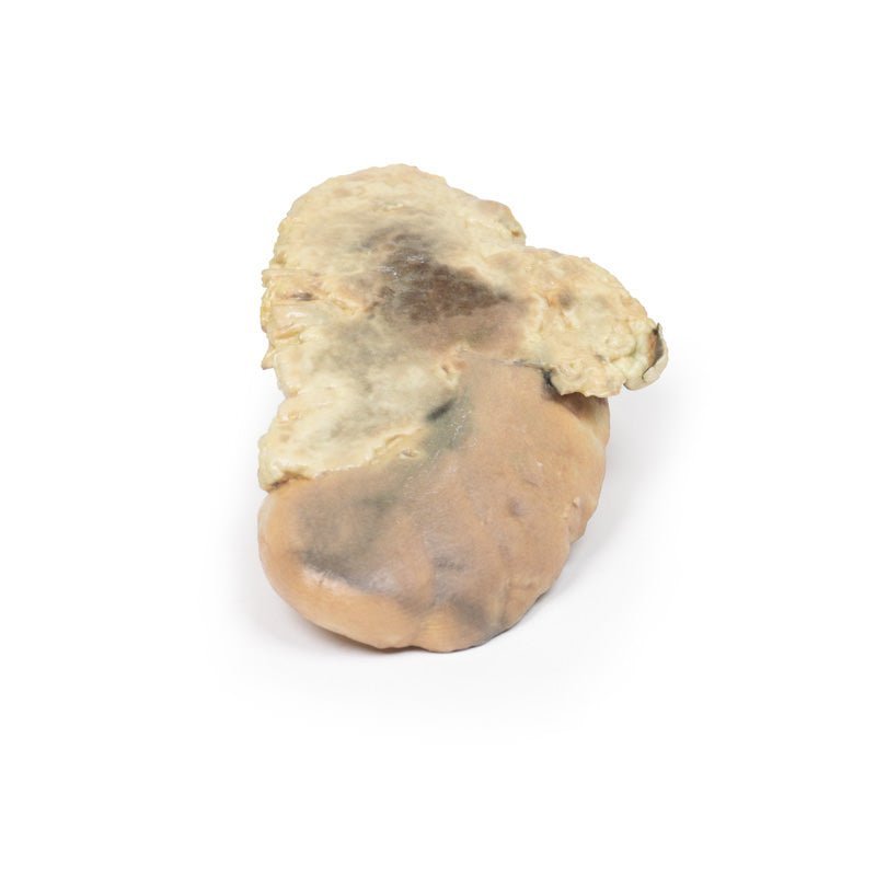 Binyreblødning (Waterhouse - Friderichsen syndrom) - eAnatomi