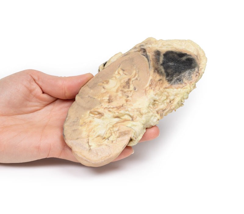 Binyreblødning / Waterhouse - Friderichsens syndrom - eAnatomi