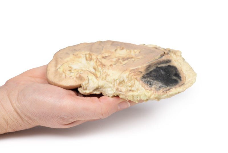 Binyreblødning / Waterhouse - Friderichsens syndrom - eAnatomi