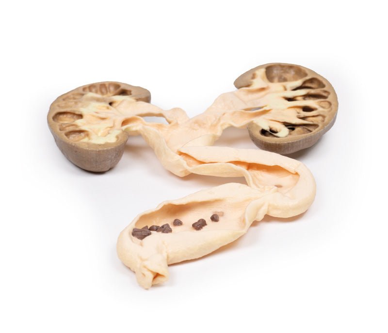 Hydronephrosis Hydroureter - eAnatomi