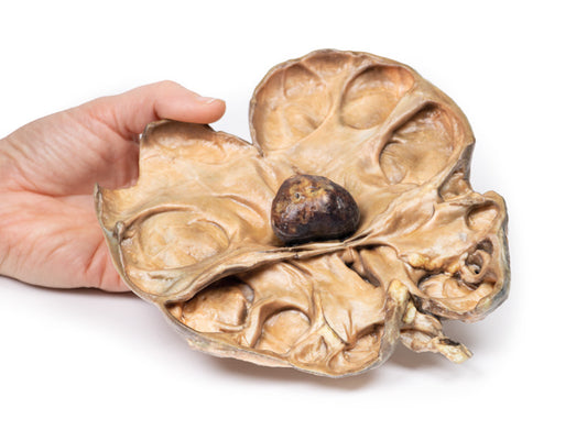 Hydronephrosis og Hydroureter forårsaget af obstruktion af en renal Calculus