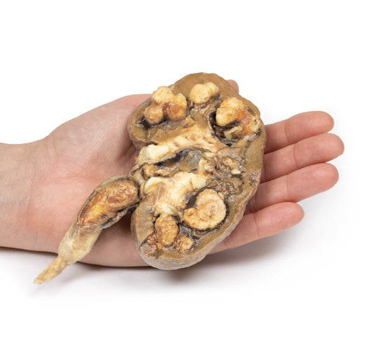 Flere renal calculi
