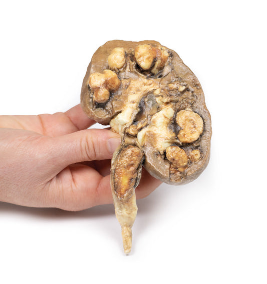 Flere renal calculi