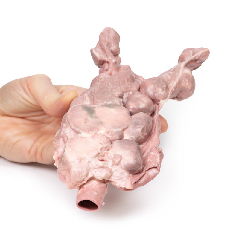 Aorta og para-aorta lymfeknuder