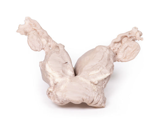 Uterus Bicornuate Unicollis