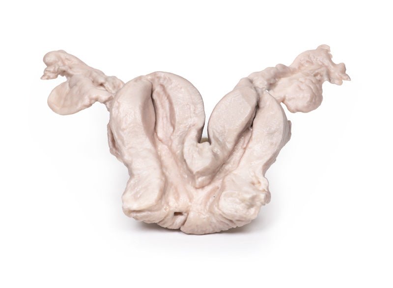 Uterus bicornis (hjerteformet livmoder) - eAnatomi
