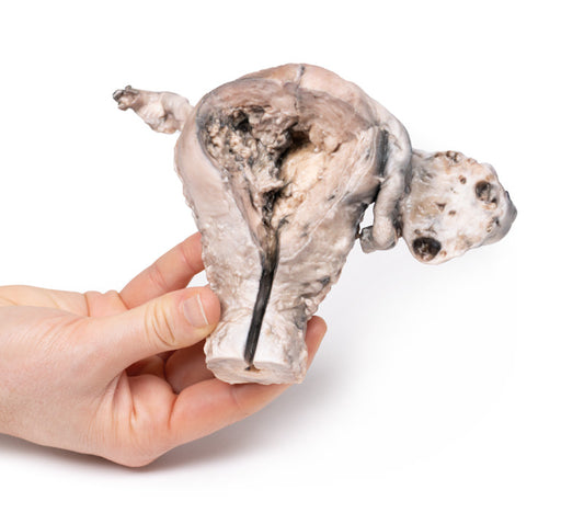 Endometriekarcinom