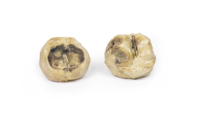 Nodulær hyperplasi af prostata - eAnatomi