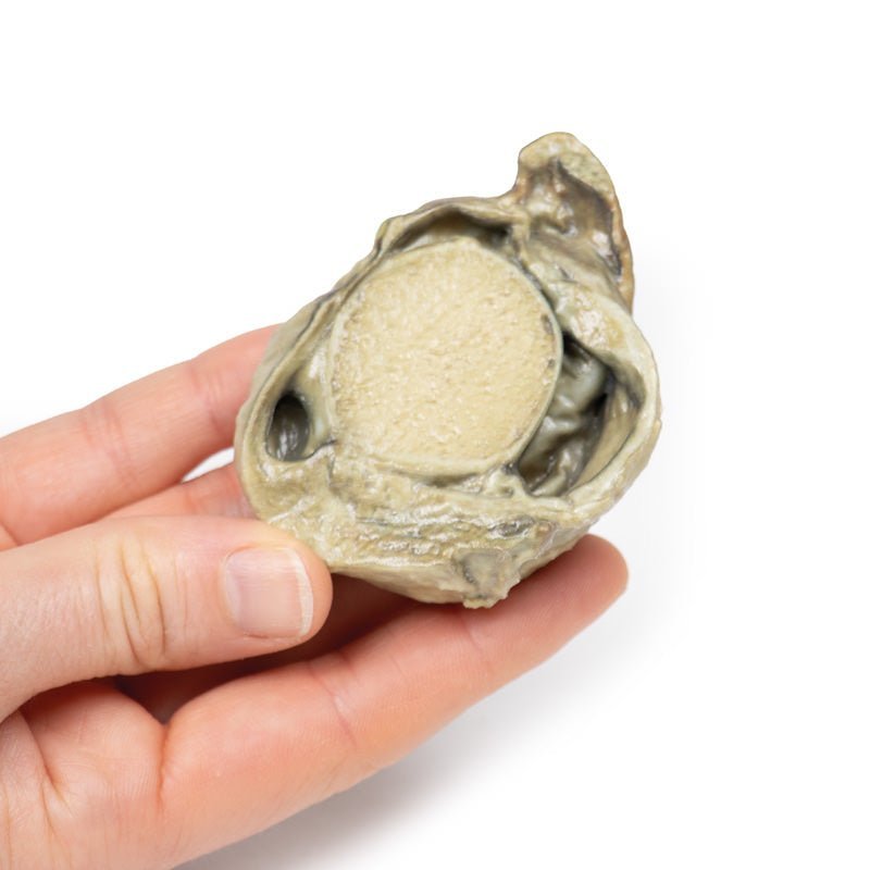 Hydrocele testis - eAnatomi