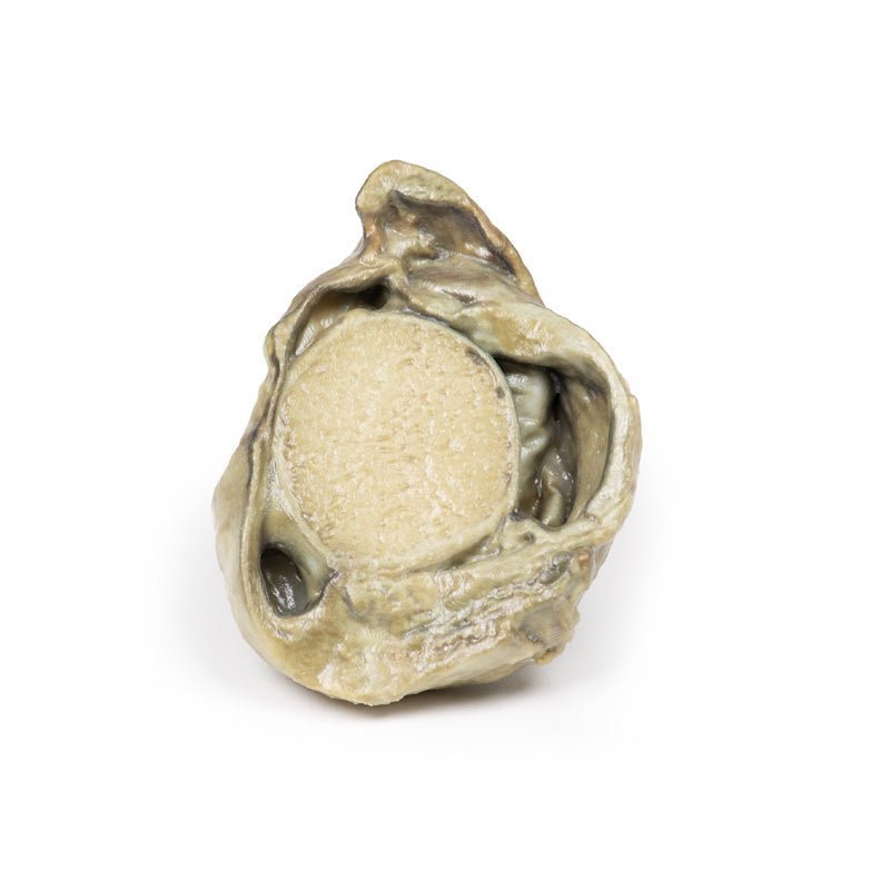 Hydrocele testis - eAnatomi