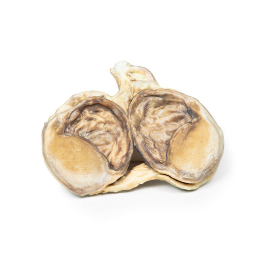 Kronisk hydrocoele