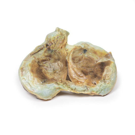 Kronisk hydrocoele