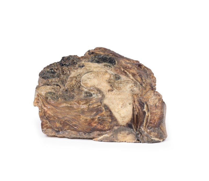 Chondrosarkom i femur og ilium - eAnatomi