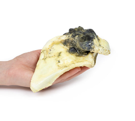 Chondrosarkom af scapula