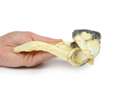 Chondrosarkom af scapula