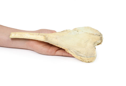 Osteosarkom af lårbenet