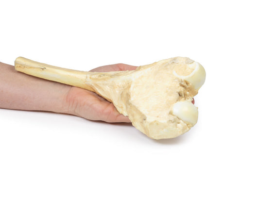 Osteosarkom af lårbenet