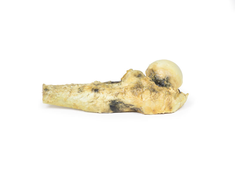 Osteosarkom af lårbenet