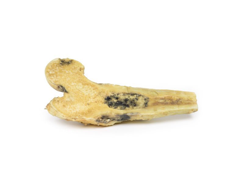 Chondrosarkom i femur - eAnatomi