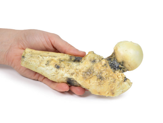 Osteosarkom af lårbenet
