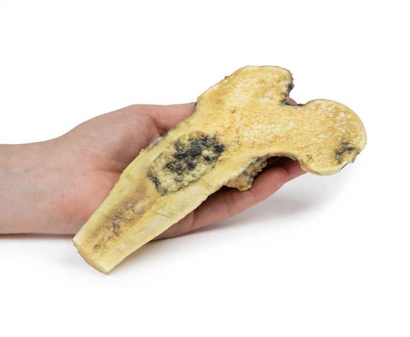 Osteosarkom af lårbenet