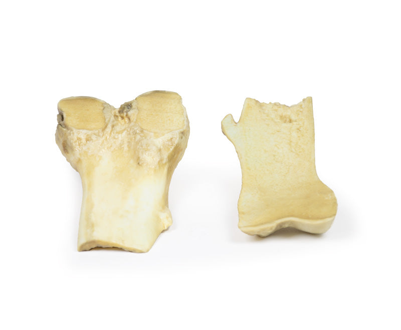 Osteochondrom