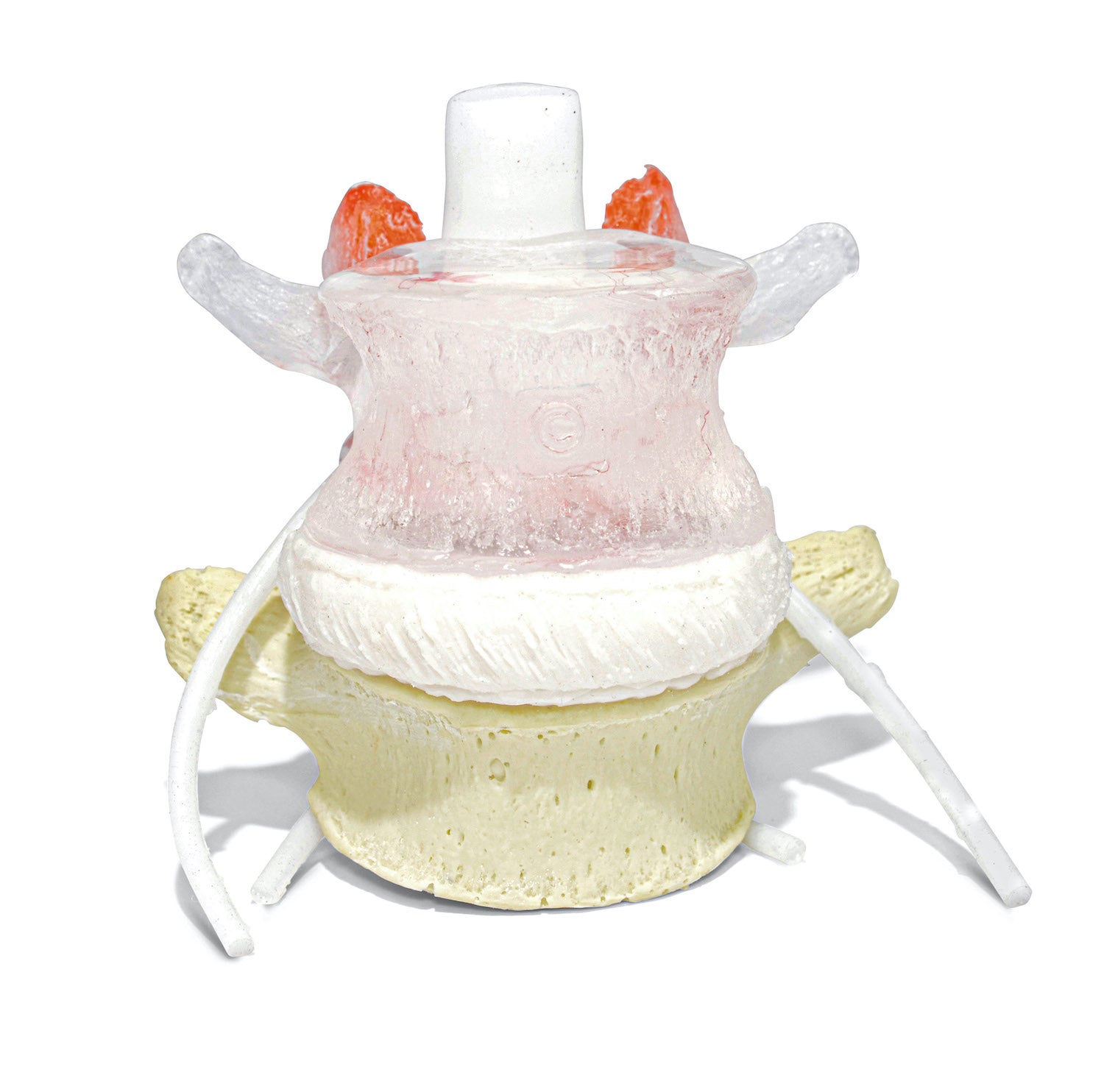 Transparent lumbar vertebra with herniated disc, vessels and internal lesions