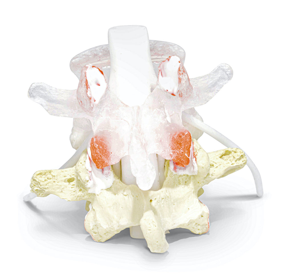 Transparent lumbar vertebra with herniated disc, vessels and internal lesions