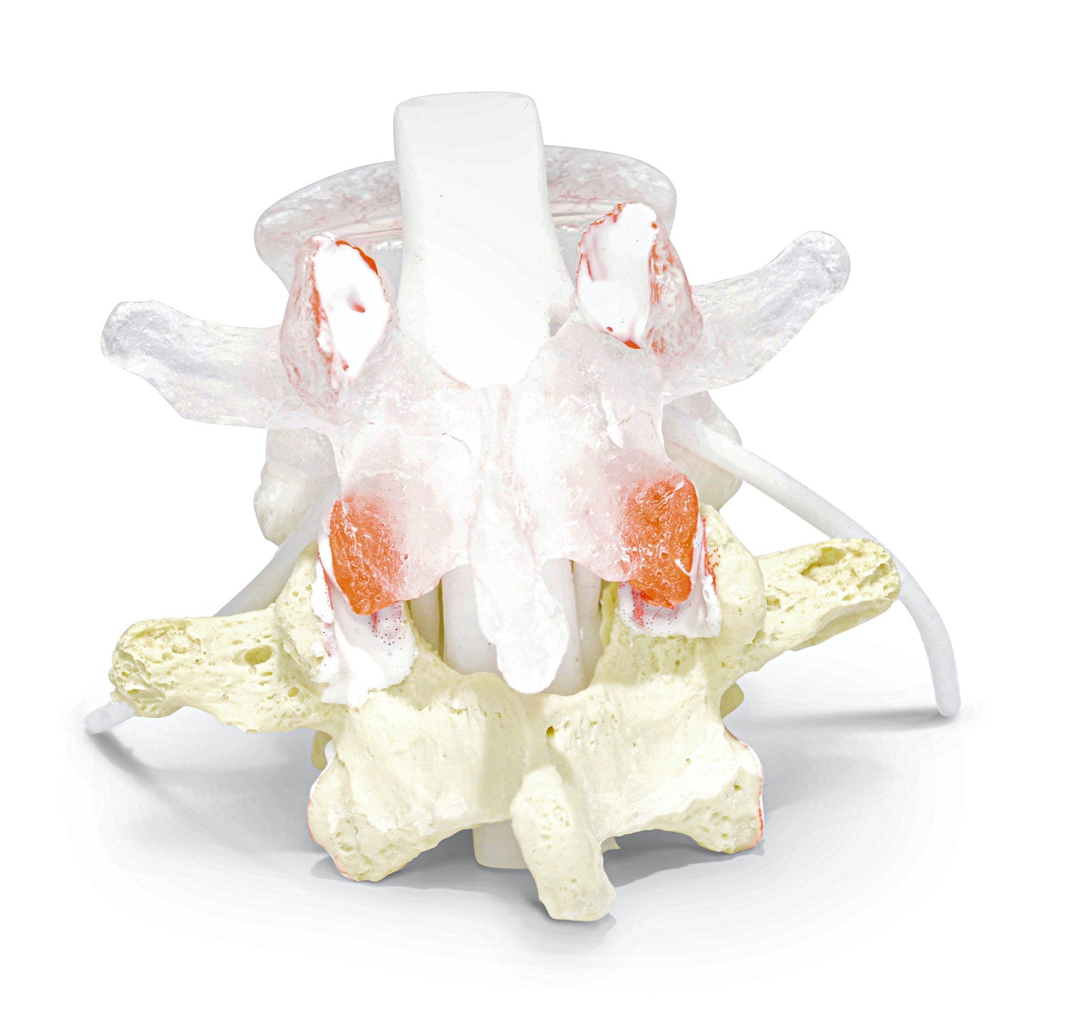 Transparent lumbar vertebra with herniated disc, vessels and internal lesions