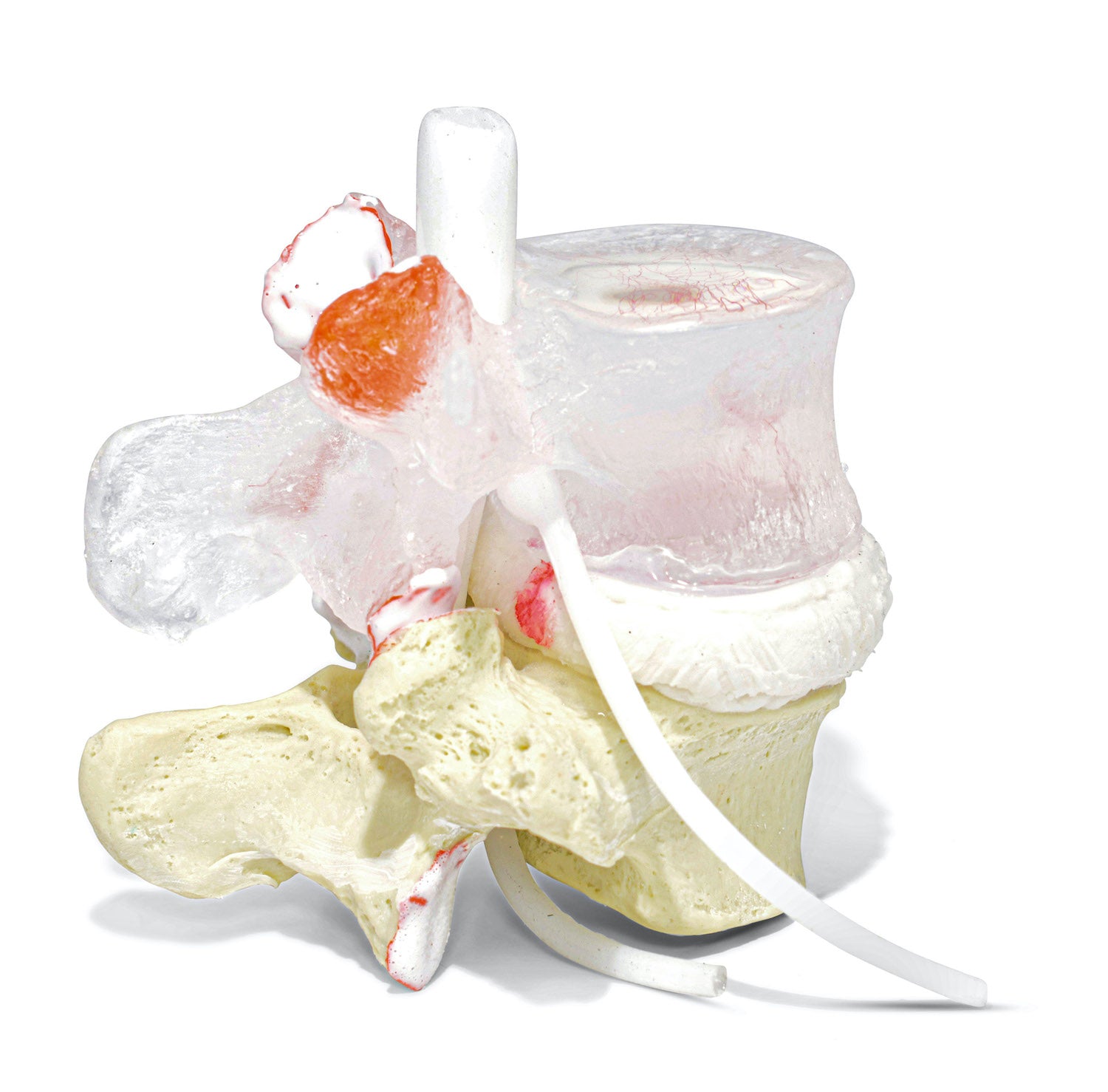 Transparent lumbar vertebra with herniated disc, vessels and internal lesions