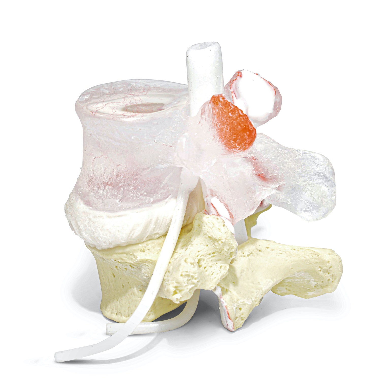 Transparent lumbar vertebra with herniated disc, vessels and internal lesions