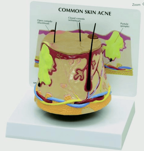 Acne, forstørret - eAnatomi