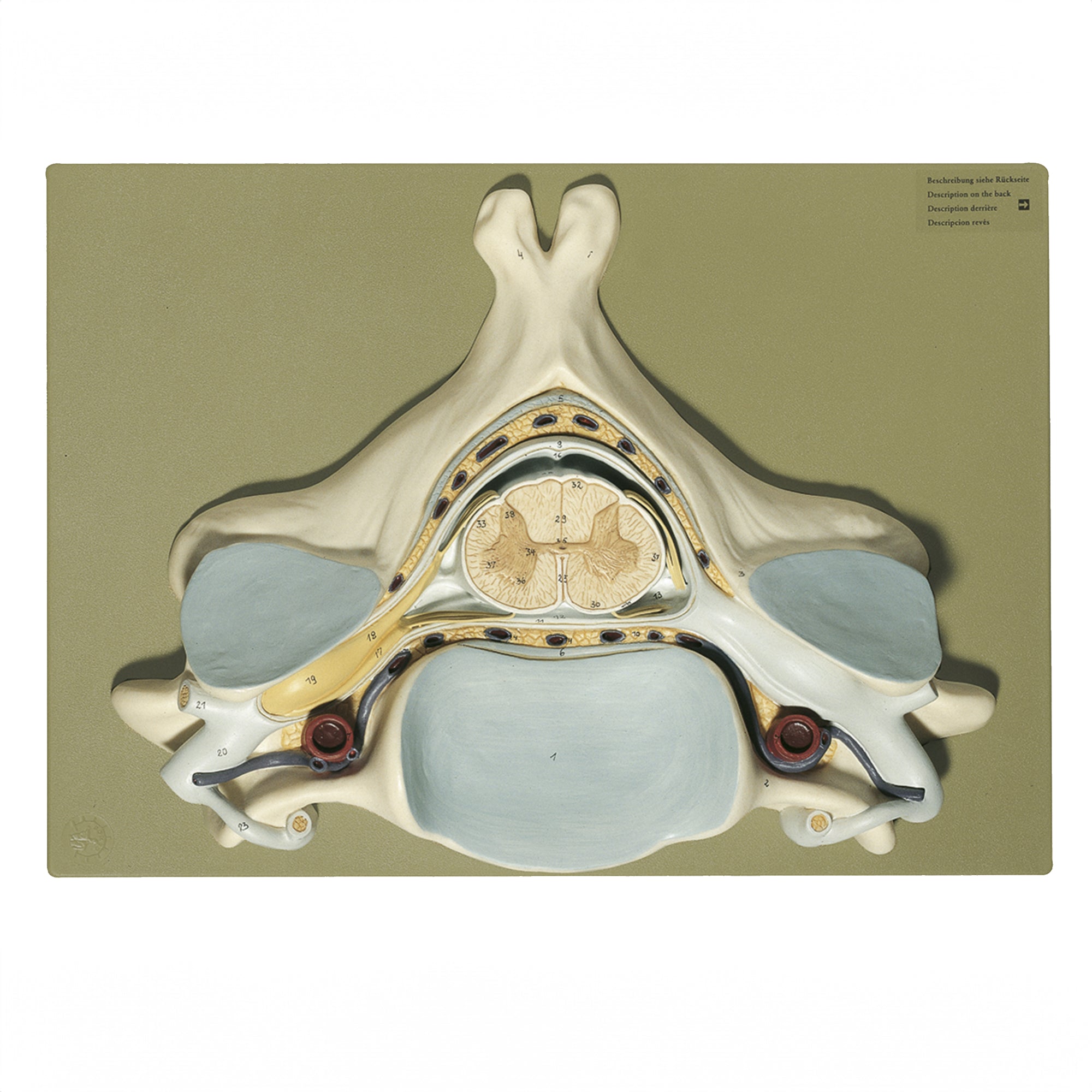 Enlarged cervical vertebra