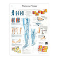 Lamineret plakat om åreknuder på engelsk - eAnatomi