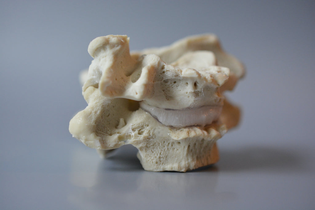 Halshvirvler m. degenerative forandringer