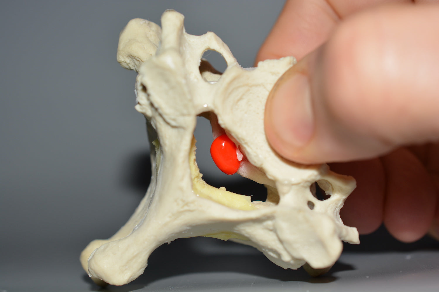Cervical vertebrae m. degenerative changes