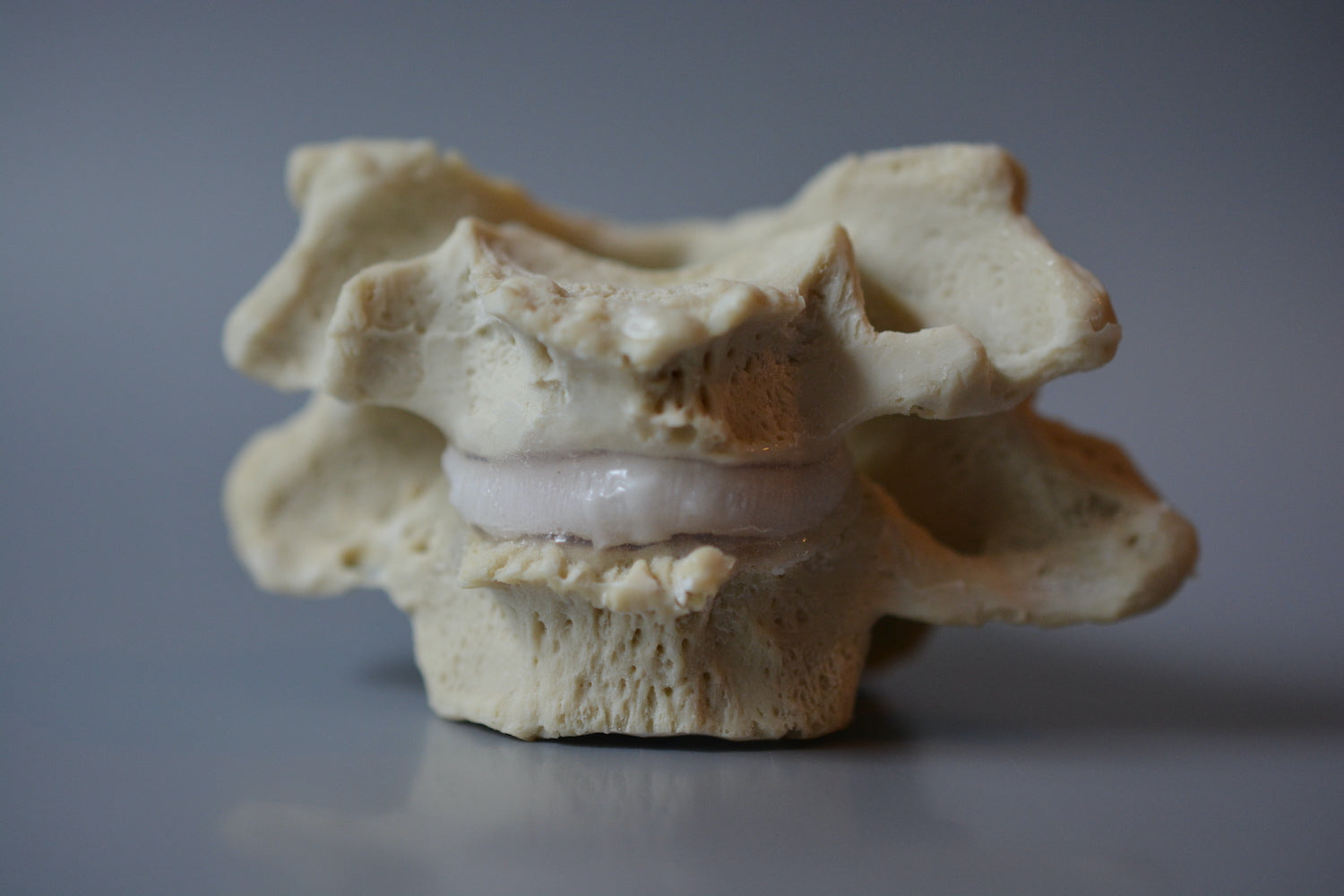 Cervical vertebrae m. degenerative changes