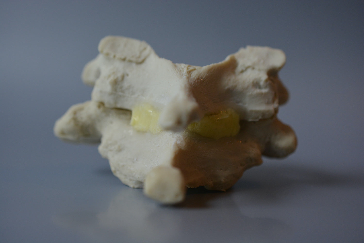 Cervical vertebrae m. degenerative changes