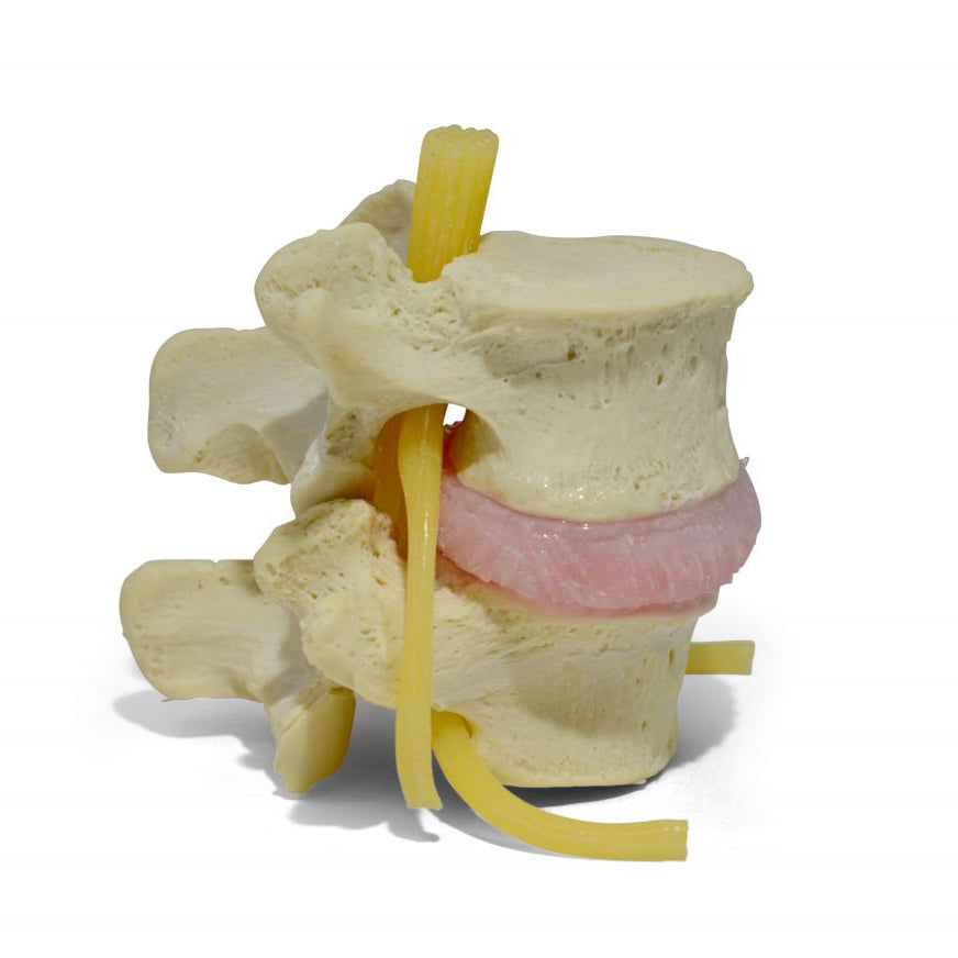 Lumbar vertebrae with herniated disc